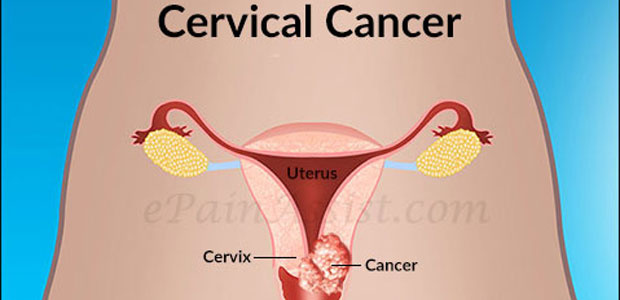Cervical cancer,Symptoms of cervical cancer,Treatment methods of cervical cancer