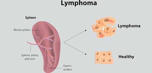 Lymphoma, lymphoma symptoms, lymphoma diagnosis, lymphoma treatment, minimally invasive therapy, St. Stamford Modern Cancer Hospital Guangzhou