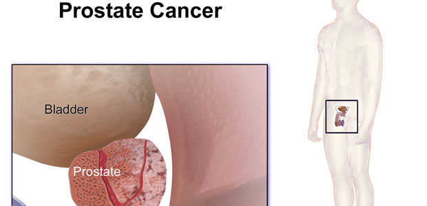 Prostate cancer,Advanced prostate cancer symptoms,Symptoms of prostate cancer,Treatment of prostate cancer