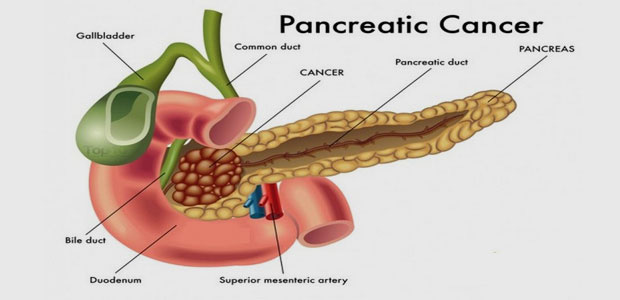 Pancreatic cancer, pancreatic cancer treatment, minimally invasive therapy, St. Stamford Modern Cancer Hospital Guangzhou