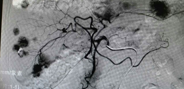  interventional therapy, St. Stamford Modern Cancer Hospital Guangzhou, microcatheter superselection, precision medical care, liver cancer, minimally invasive treatment