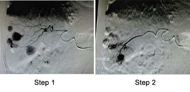  interventional therapy, St. Stamford Modern Cancer Hospital Guangzhou, microcatheter superselection, precision medical care, liver cancer, minimally invasive treatment