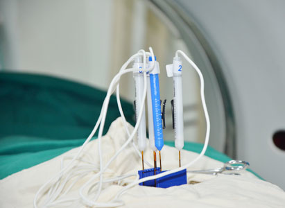 Modern Cancer Hospital Guangzhou, nanoknife, treatment for pancreatic cancer Modern Cancer Hospital Guangzhou, nanoknife, treatment for pancreatic cancer