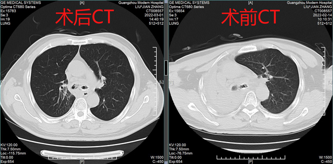 术前术后CT表现-2.jpg