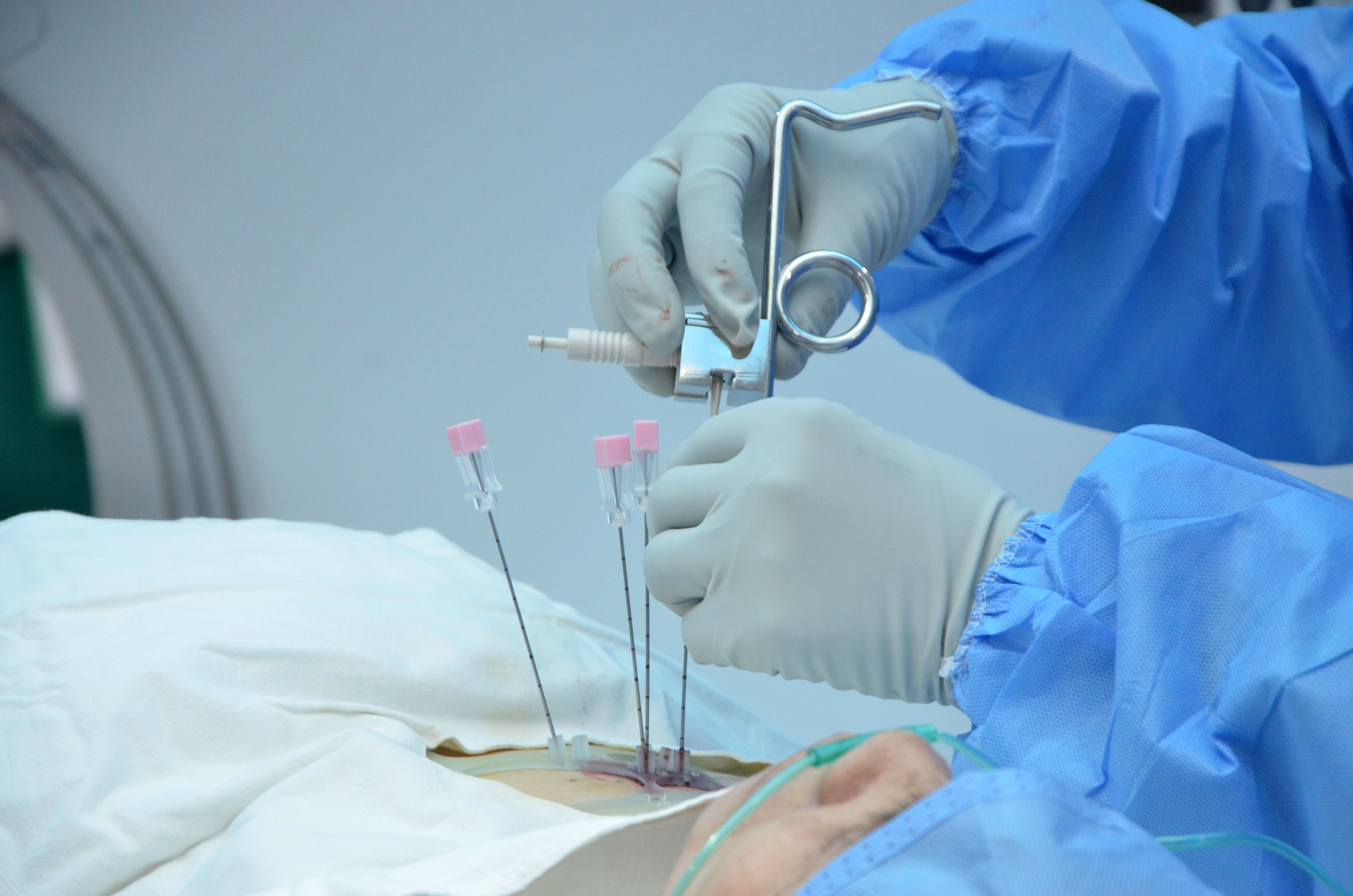 新高度！广州现代肿瘤医院成功实施3D微创导向模板引导下的I125粒子植入术